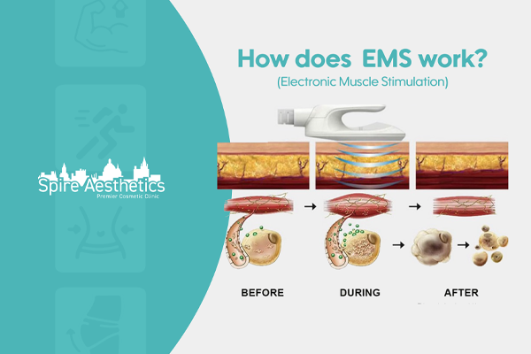 EMS treatment for post pregnancy weight loss treatment Windsor