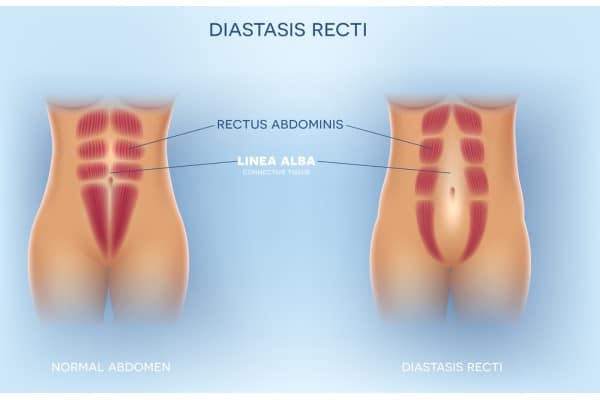 What Non-Surgical Options Are Available for Diastasis Recti Windsor?