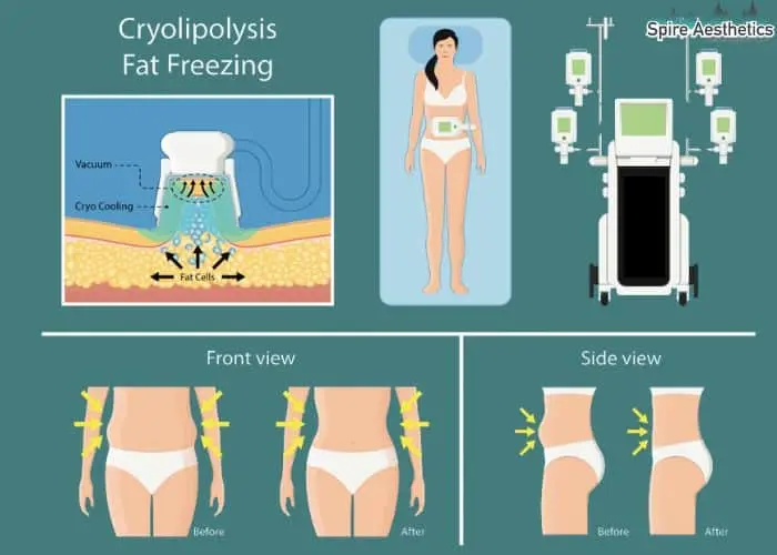 Fat freezing treatment Windsor benefits for competitions to remove stubborn fat deposits.
