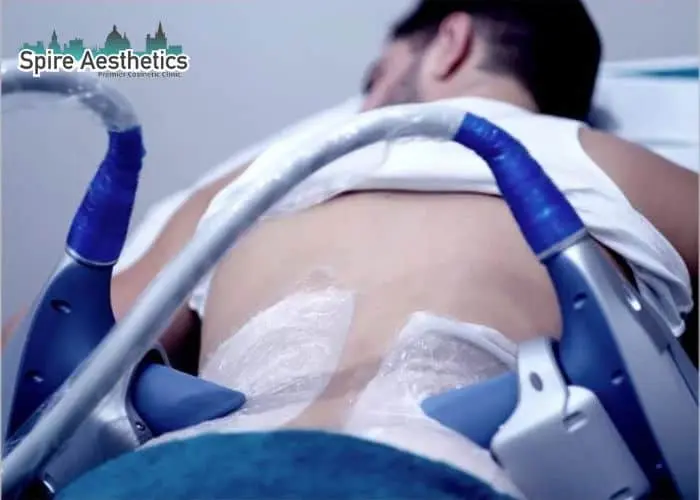 Man having fat freezing treatment done on love handles before a competitions Windsor to create a sculpted look.