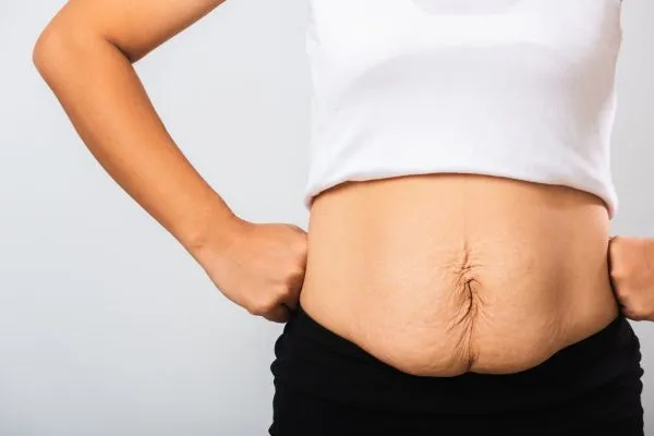 Image of a woman's stomach after weight loss with sagging skin following a gastric band Windsor