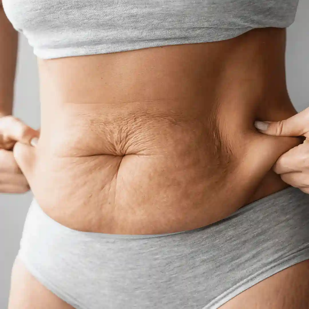 Is It Normal to Have Loose Skin After Pregnancy Windsor?