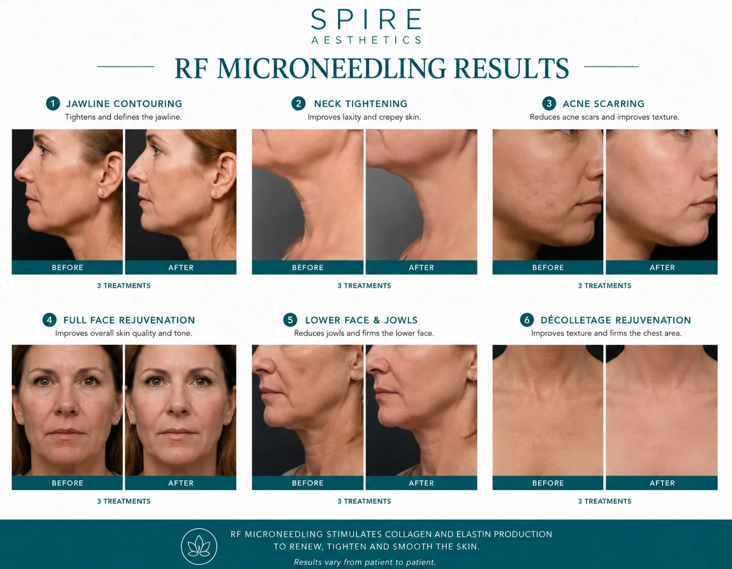 RF Microneedling Skin tightening Windsor results