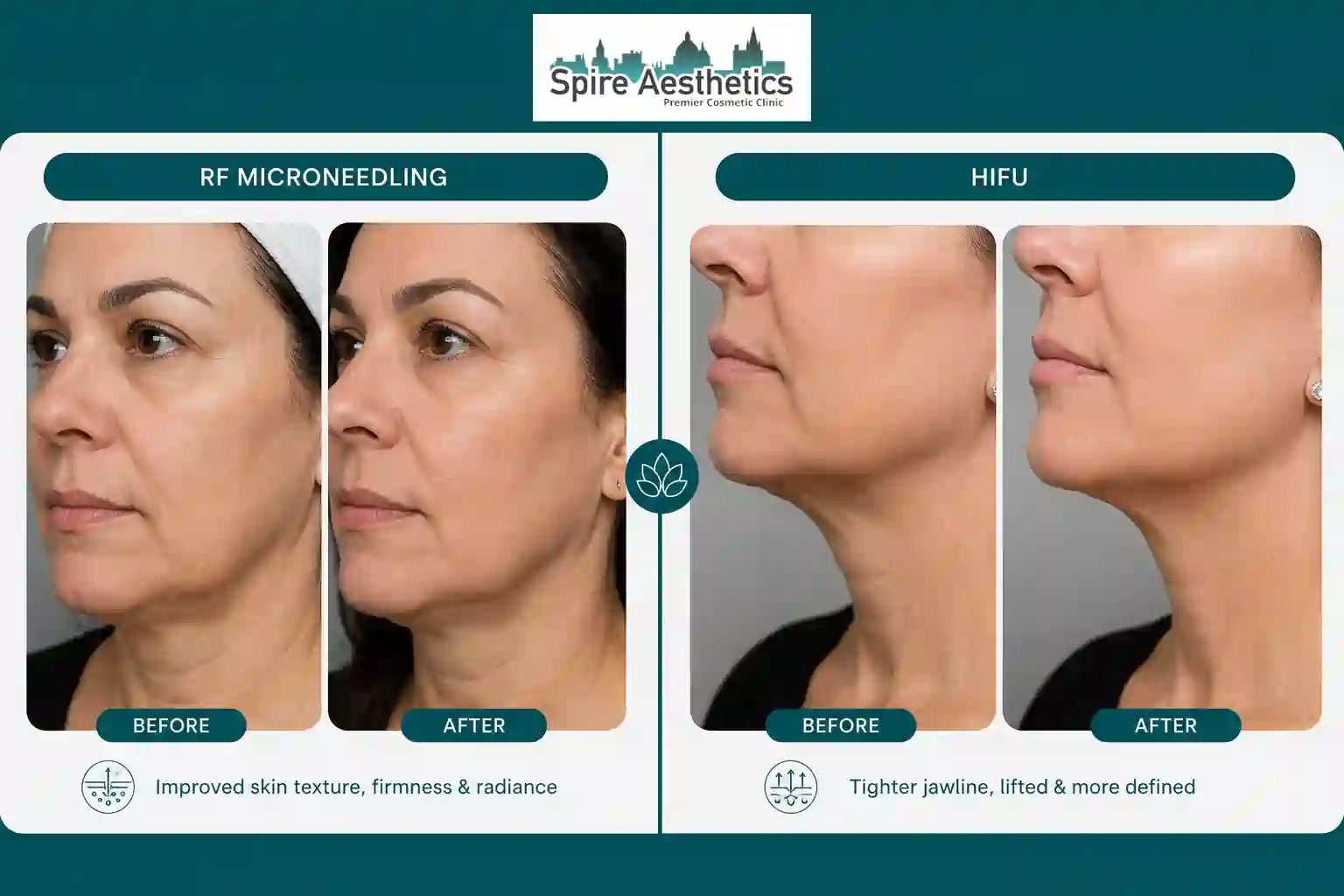 Can RF Microneedling and HIFU Be Combined Windsor?