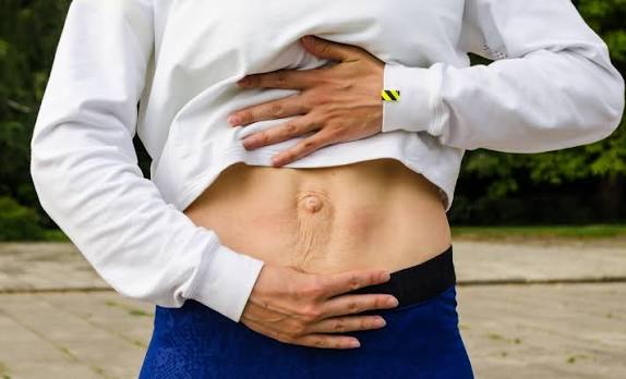 When Could Diastasis Recti Be the Missing Piece of the Puzzle Windsor?