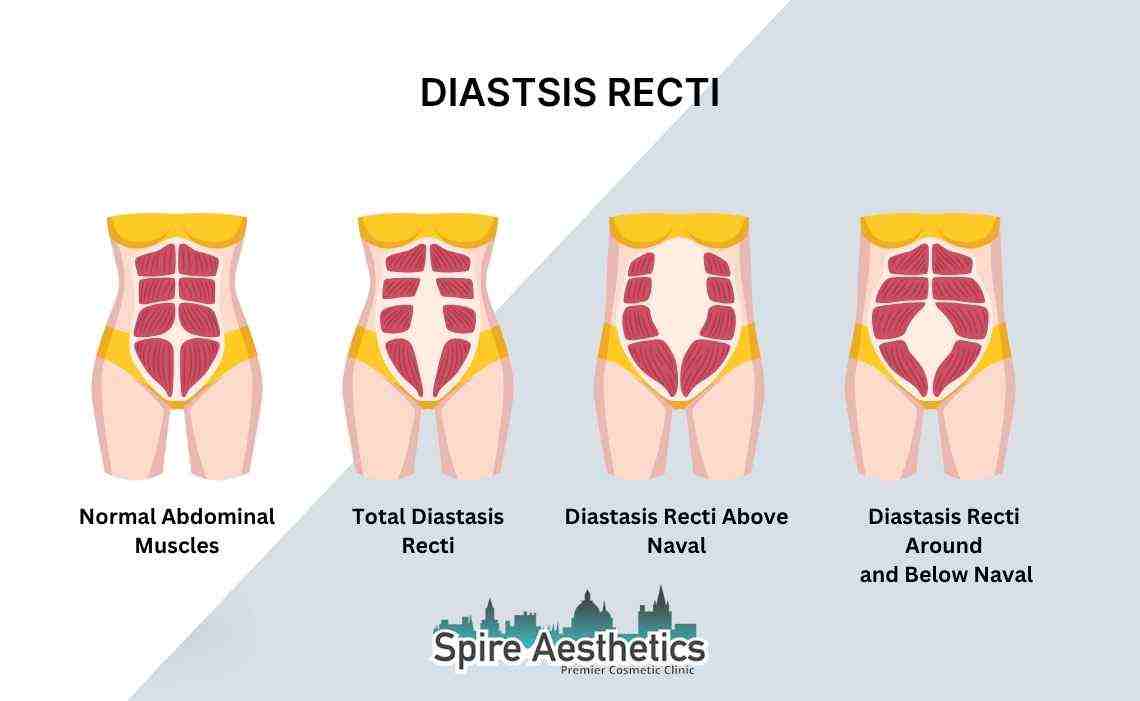 Is Non-Surgical Diastasis Recti Treatment Right for You? Common Concerns Answered Windsor